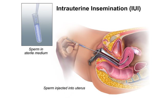 ovulation induction IUI چیست؟ همه آنچه که باید در ارتباط با آن بدانید مدبی